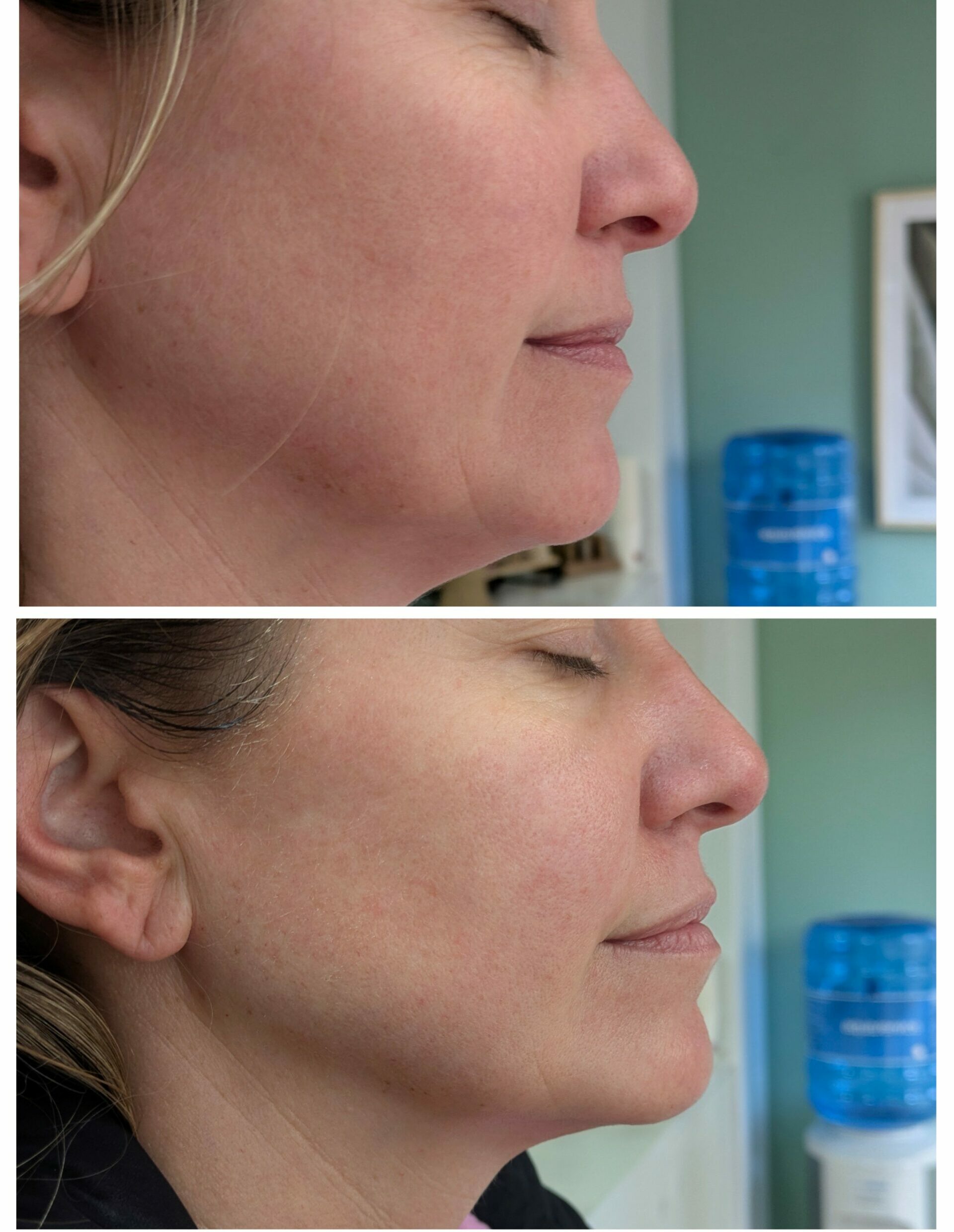 decongesting inflamation face