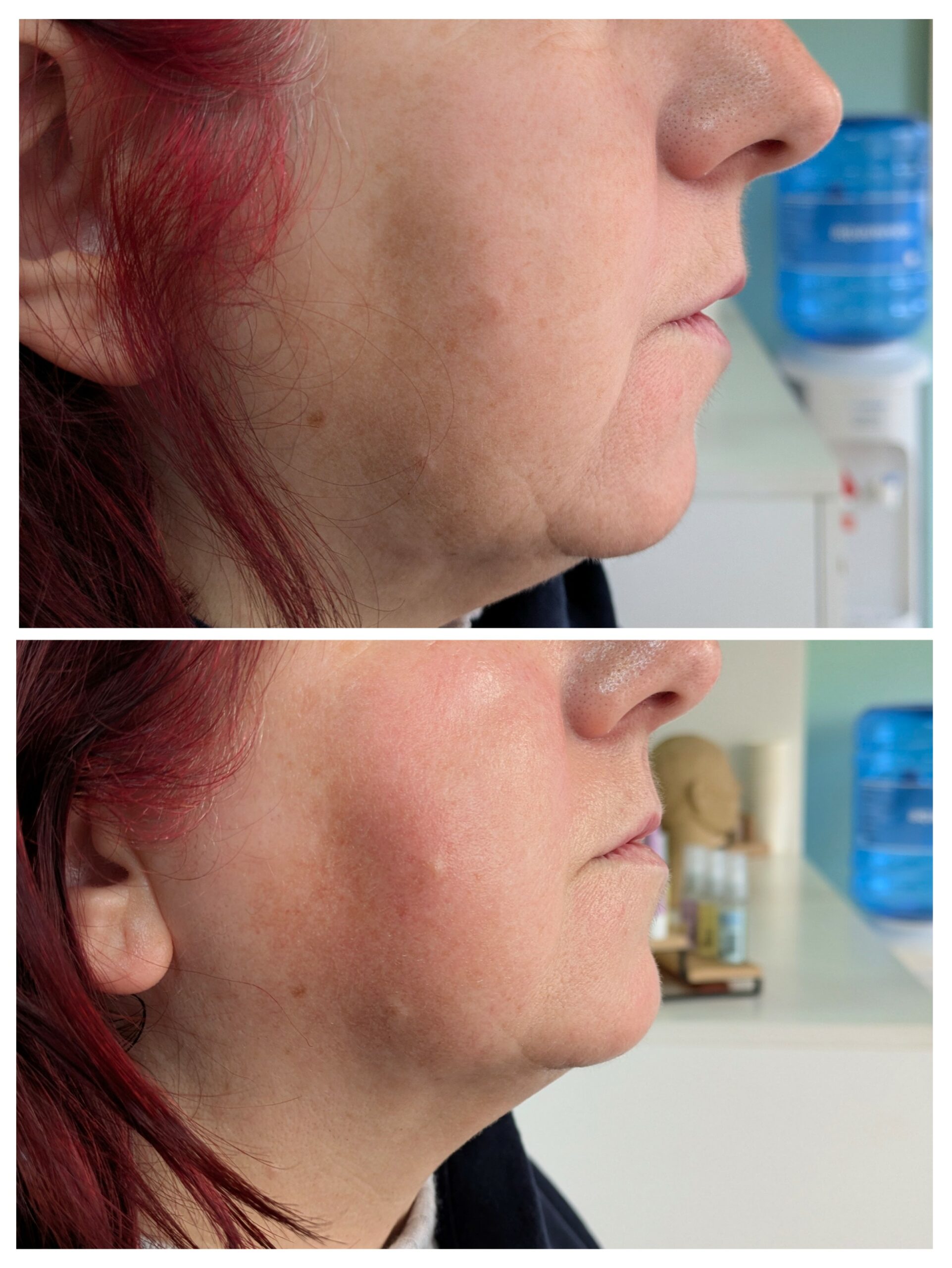 lift cheekbones, improve complexion and double chin