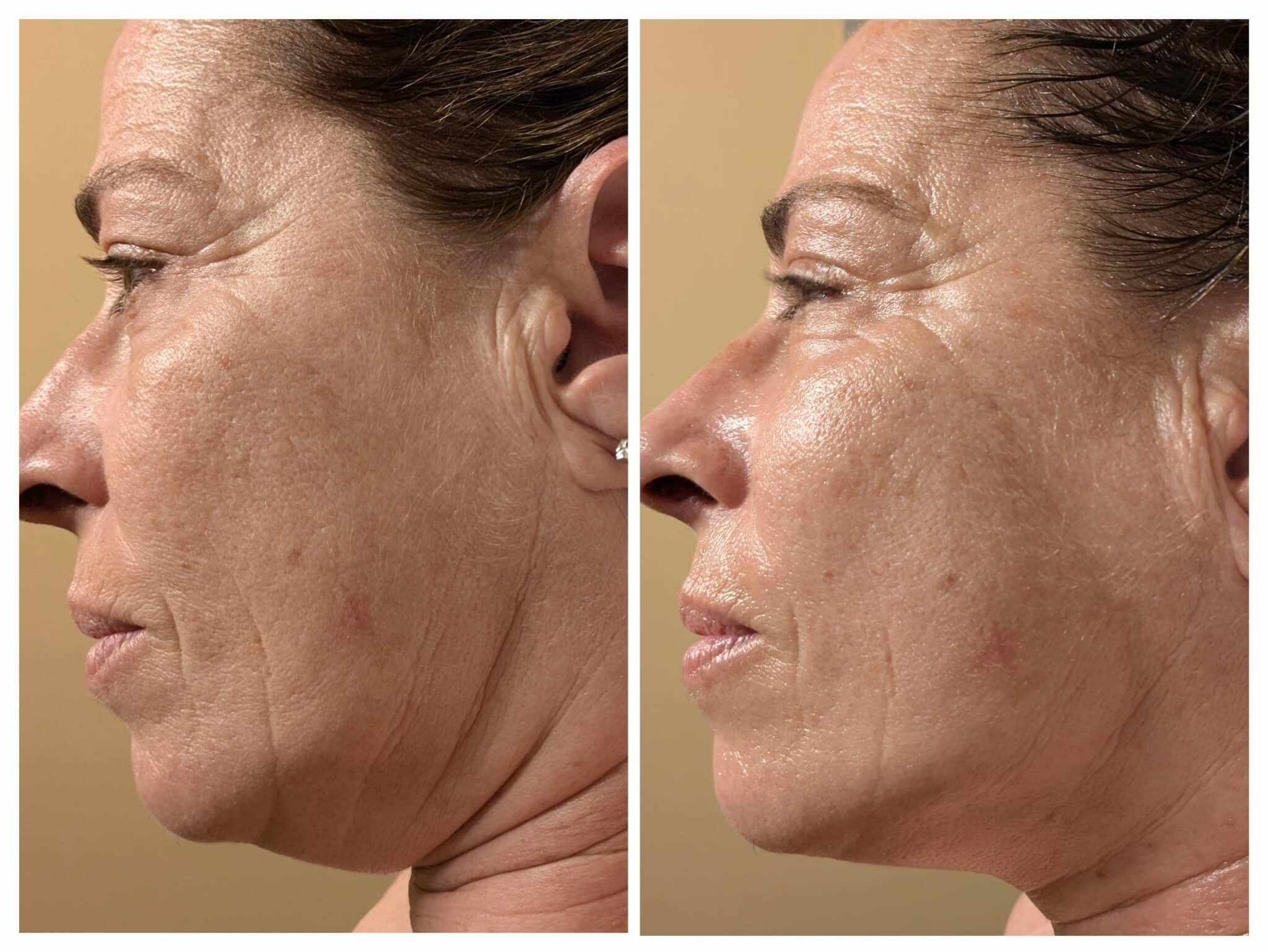 Ejemplo antes y después de un tratamiento facial manual realizado por Marine Lefevre en L’Eliana